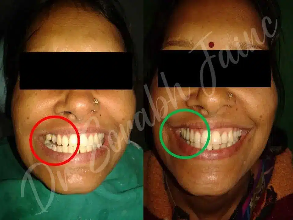 Smile Correction with Fixed Teeth | Dr Prostho Dental Solution | Manage TMJ Pain