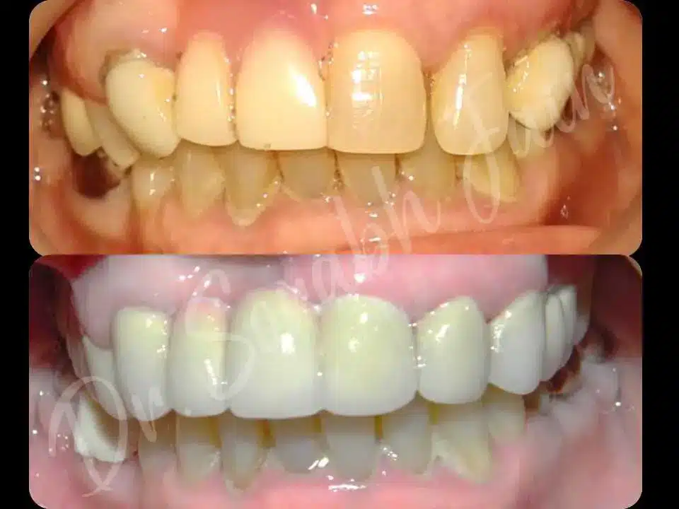 Smile designing | Dr Prostho Dental Solution | Manage TMJ Pain
