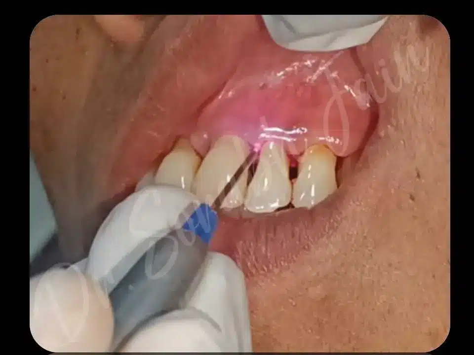 Laser treatment | Dr Prostho Dental Solution | Manage TMJ Pain