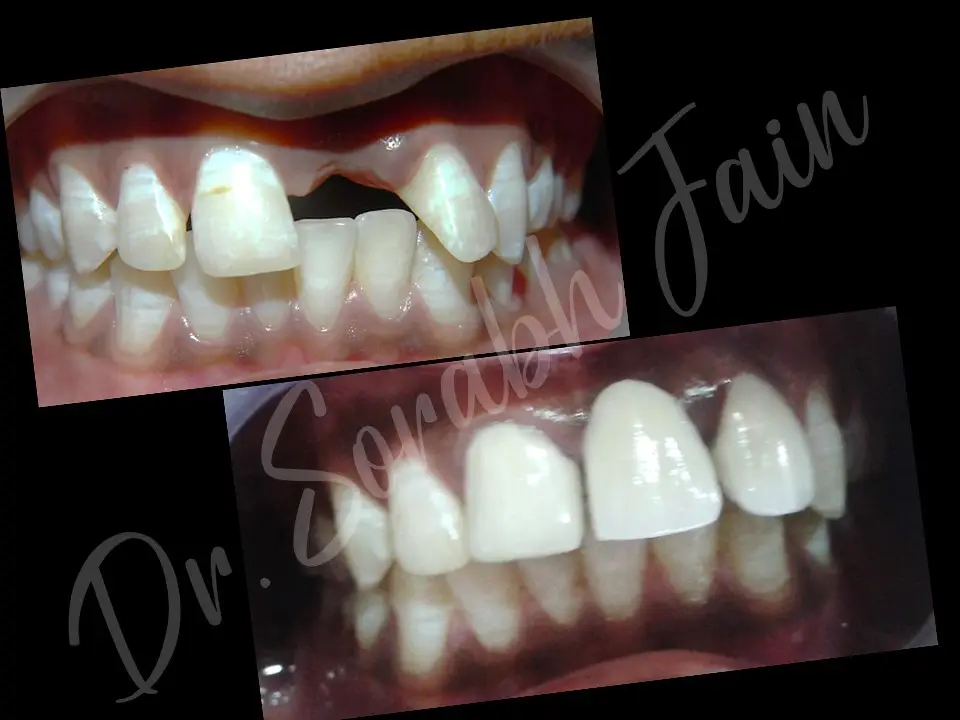 Fixed Teeth | Dr Prostho Dental Solution | Manage TMJ Pain