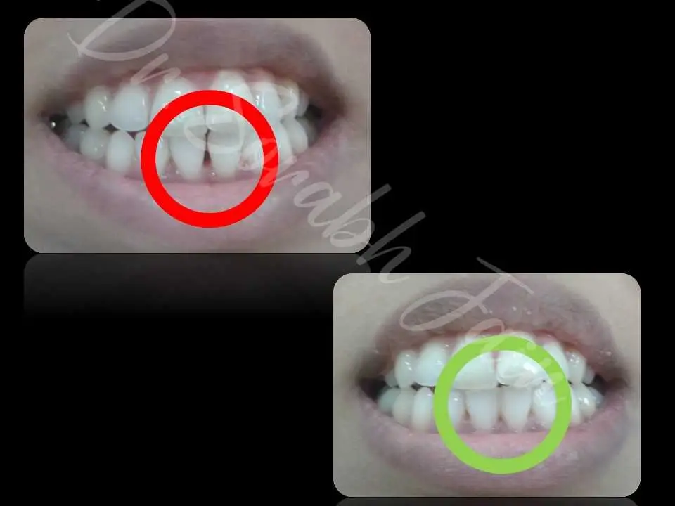 Cosmetic filling | Dr Prostho Dental Solution | Manage TMJ Pain