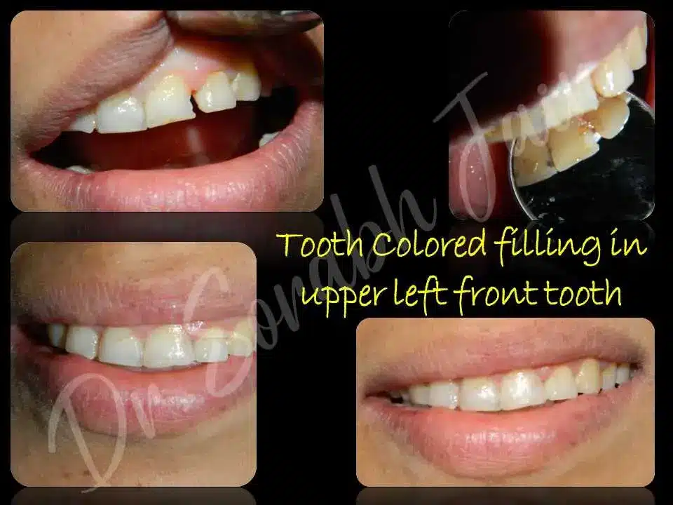 Single Tooth Filling | Dr Prostho Dental Solution | Manage TMJ Pain