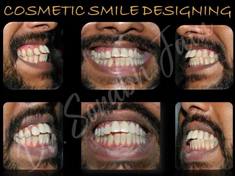 Composite Filling (light Cure filling) | Dr Prostho Dental Solution | Manage TMJ Pain