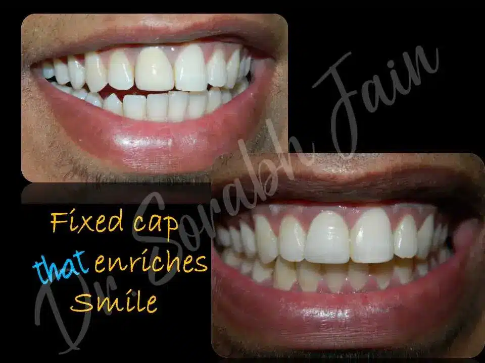 Fixed Teeth | Dr Prostho Dental Solution | Manage TMJ Pain