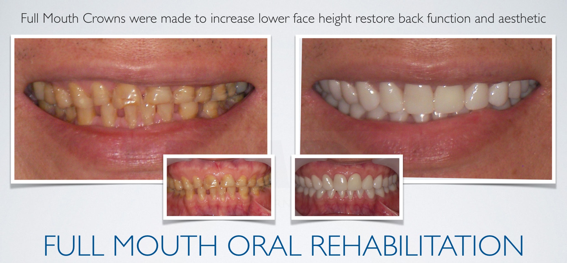 Dr Sorabh Jain | Dr Prostho Dental Solution | Manage TMJ Pain