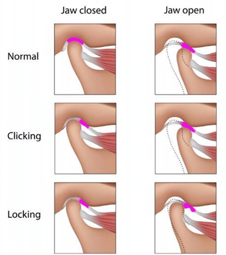 Dr Sorabh R. Jain | Jaw Locking Treatment in Mumbai