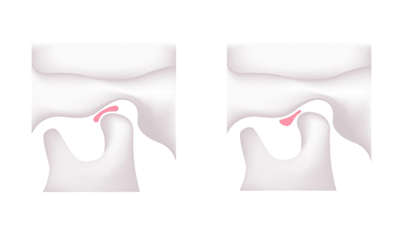 Dr Sorabh R. Jain |TMJ-Jaw Locking Treatment in Mumbai