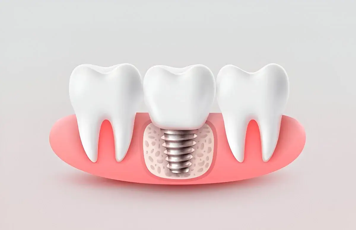 Dental implants Mumbai, prosthodontist for dental implants Mumbai